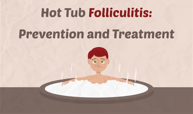 Hot Tub Infection Folliculitis Acsbr Nccsea